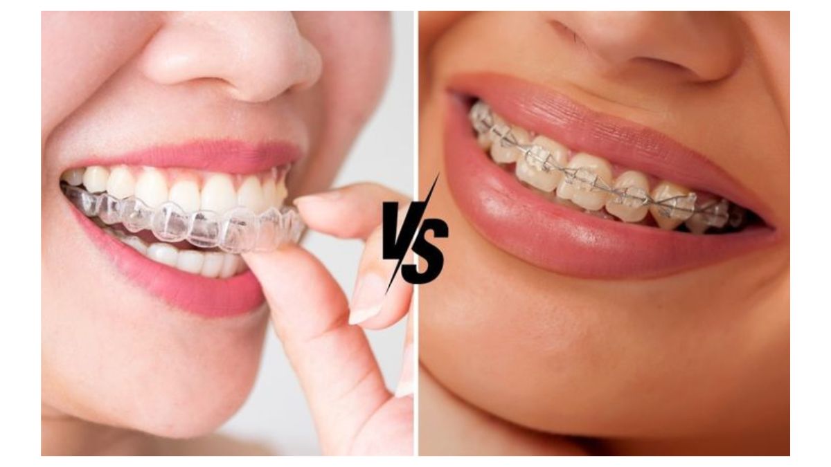 Сравнение брекетов и элайнеров Invisalign