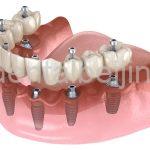 Dental implant