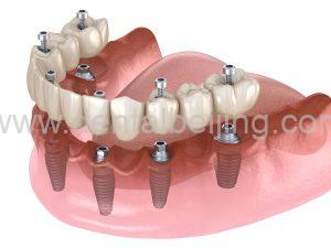 Dental implant
