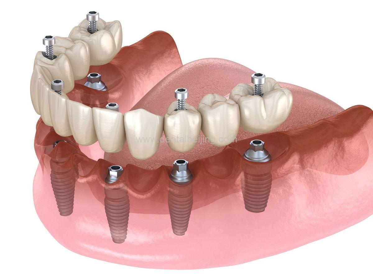 Dental implant