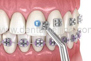 Metal Braces