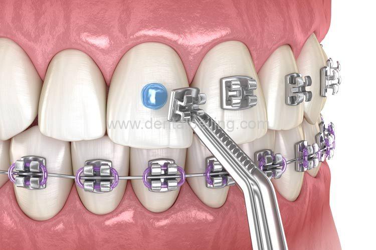Metal Braces