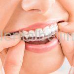 dental retainer