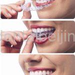 invisible braces beijing
