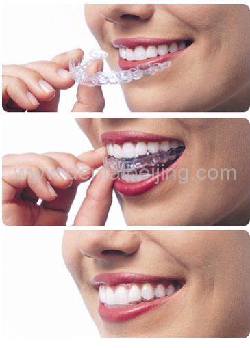 invisible braces beijing