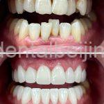 E-max Veneers: The Perfect Solution for a Radiant Smile