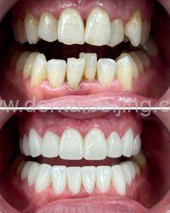E-max Veneers: The Perfect Solution for a Radiant Smile