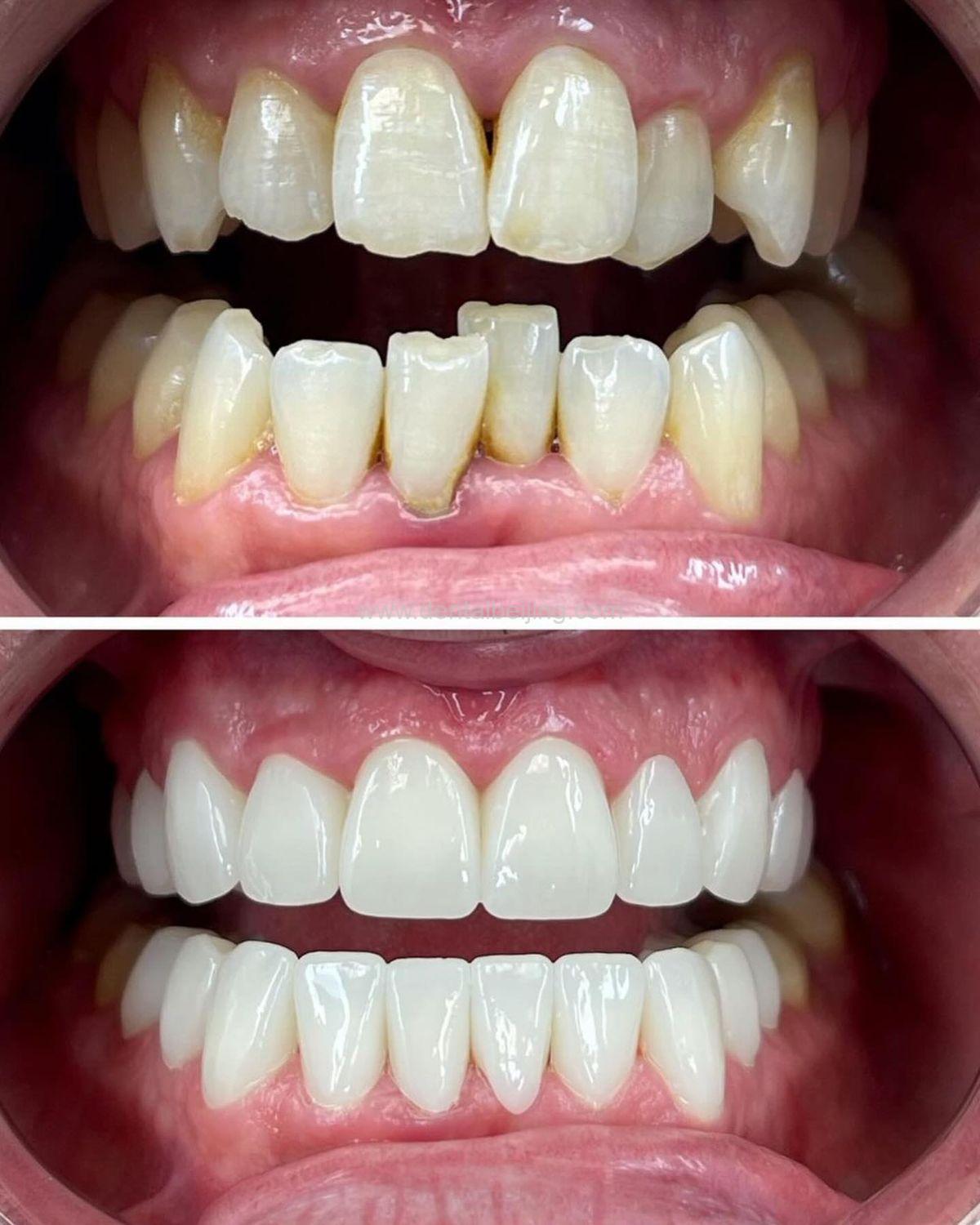 E-max Veneers: A Durable, Aesthetic Solution for Your Smile - Beijing ...