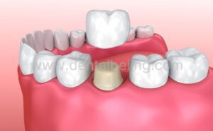 Dental Crown Replacement in Beijing