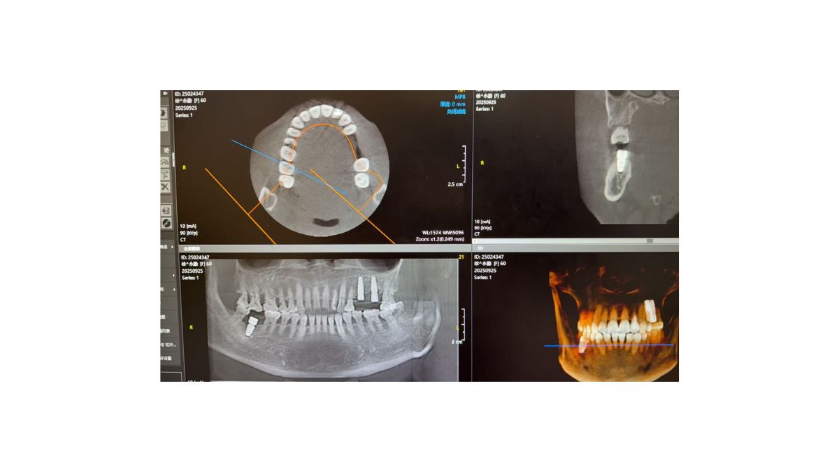 AI Robot Dental Implant Surgery Demo - Beijing Keer